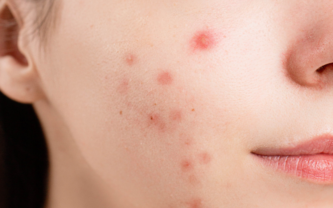 Si të shpëtoni nga aknet? Udhëzuesi i plotë për një lëkurë të pastër…