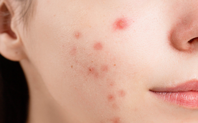 Si të shpëtoni nga aknet? Udhëzuesi i plotë për një lëkurë të pastër…