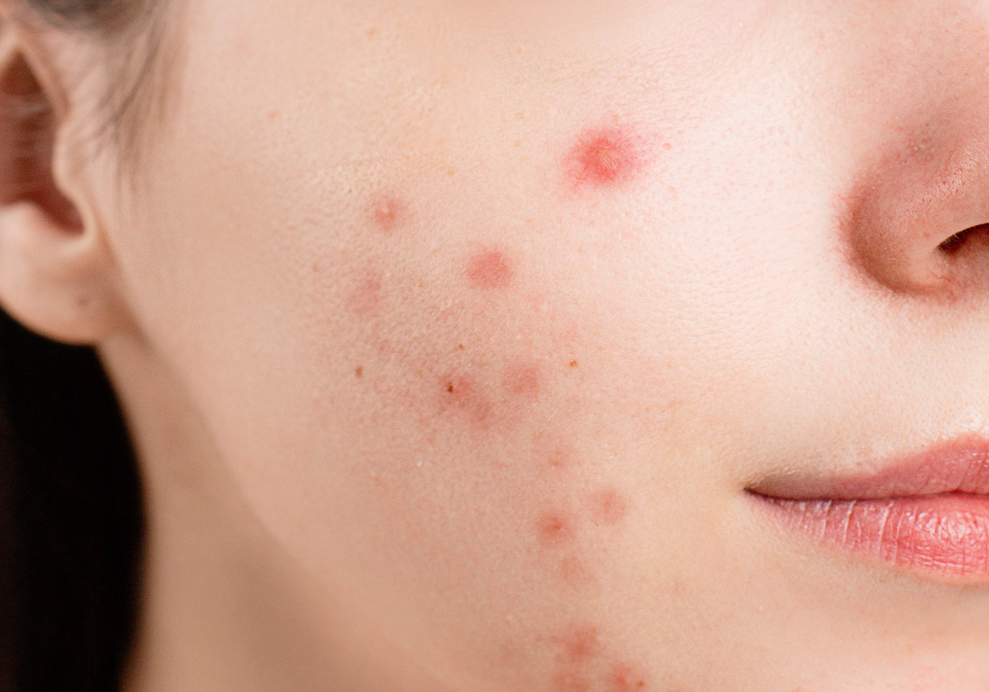 akne